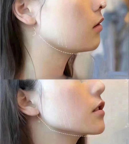 Diaminy Mono Threads Jawline