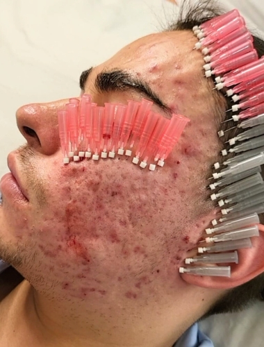Diaminy Mono Threads for Acne