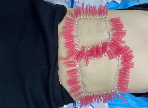 Diaminy Mono threads for Stretch marks