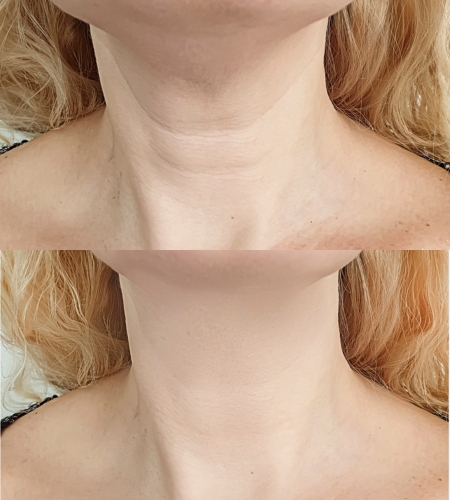 Diaminy smmoth Threads neck