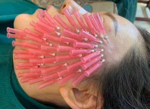 Mono Threads for Face Tighten