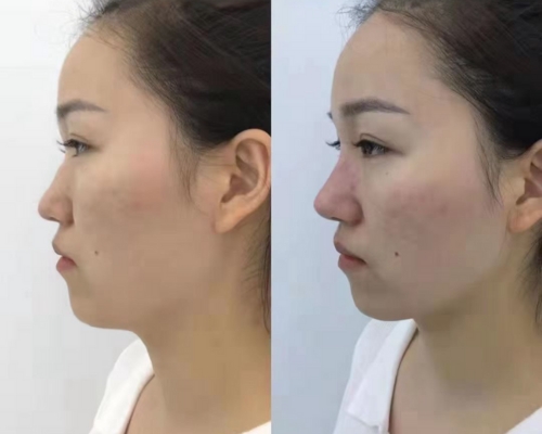 pdo nose thread lift before and after 1
