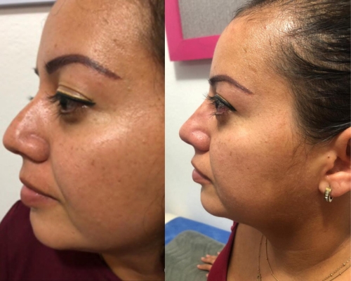 pdo nose thread lift before and after 5