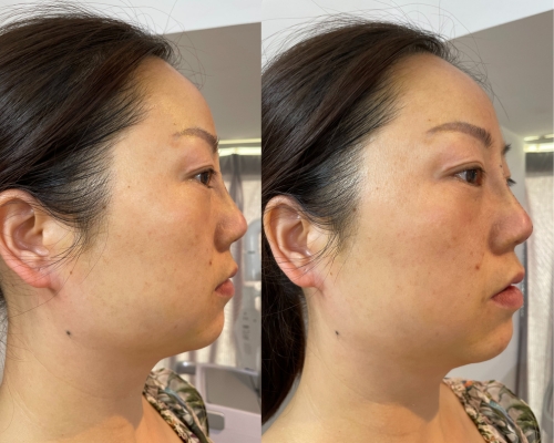 pdo nose thread lift before and after 6