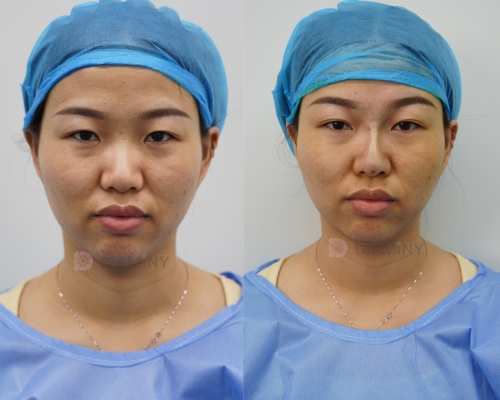 pdo nose thread lift before and after