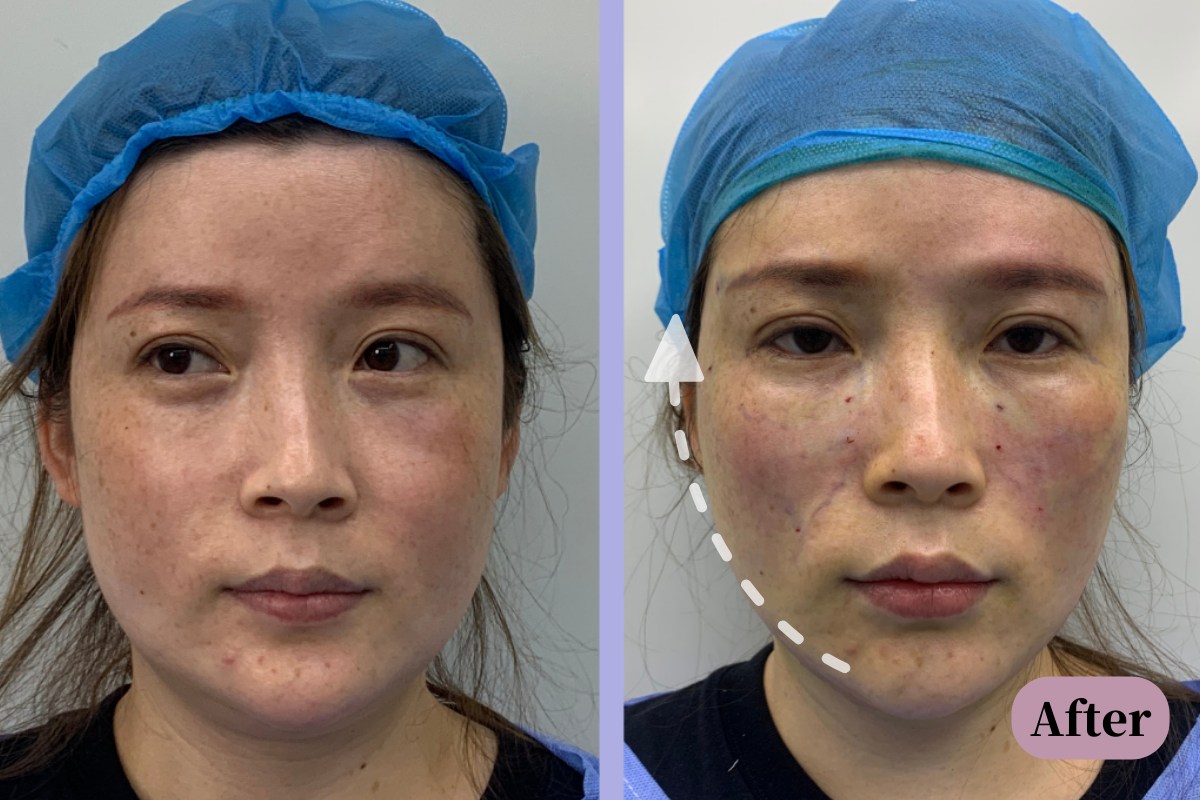 Diaminy PCL thread before and after