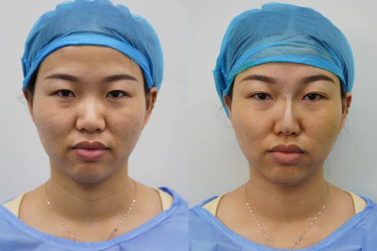 Diaminy nose thread lift before and after
