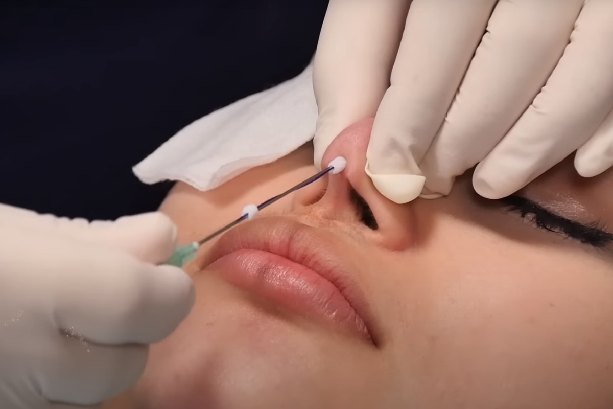 nose thread lift