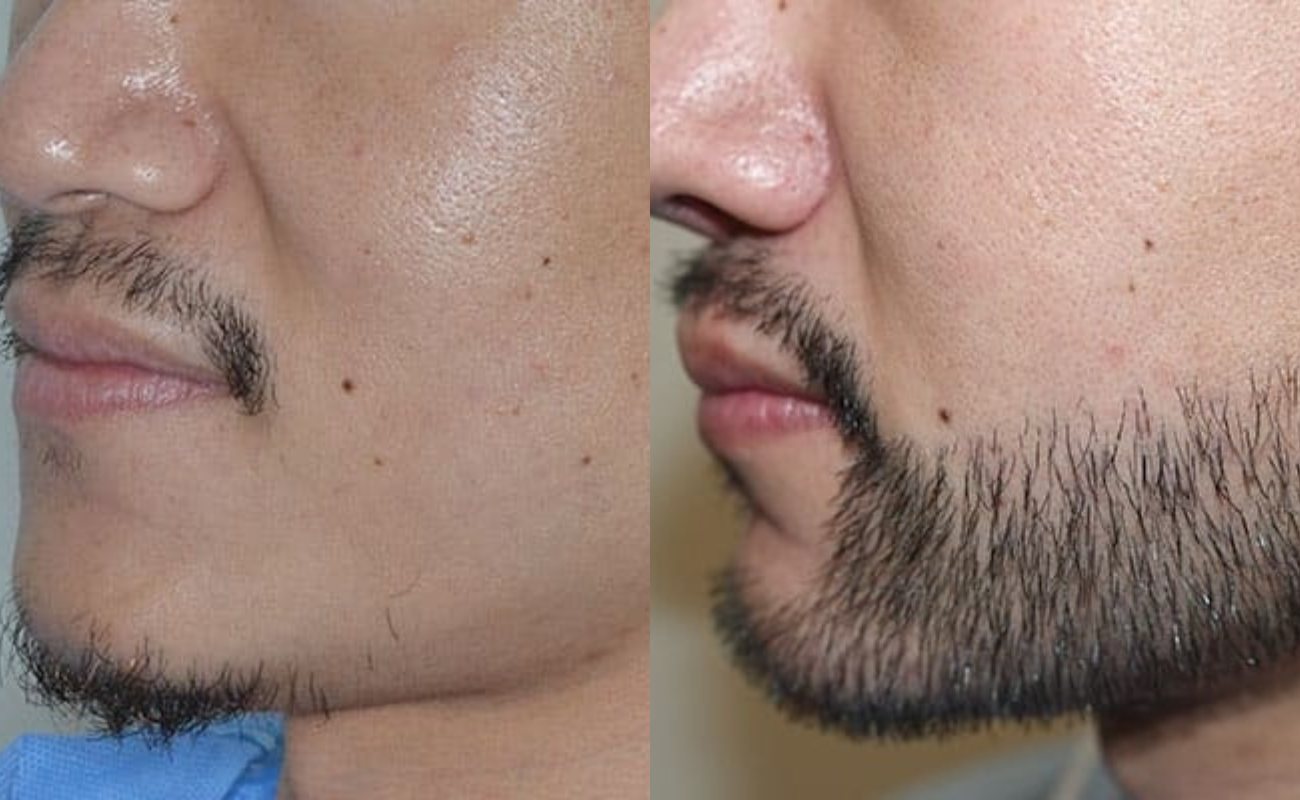 Derma Roller for Beard