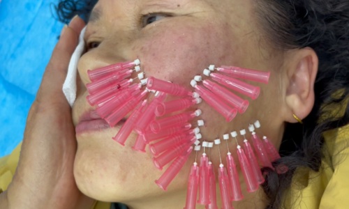 PDO mono thread lift for cheek