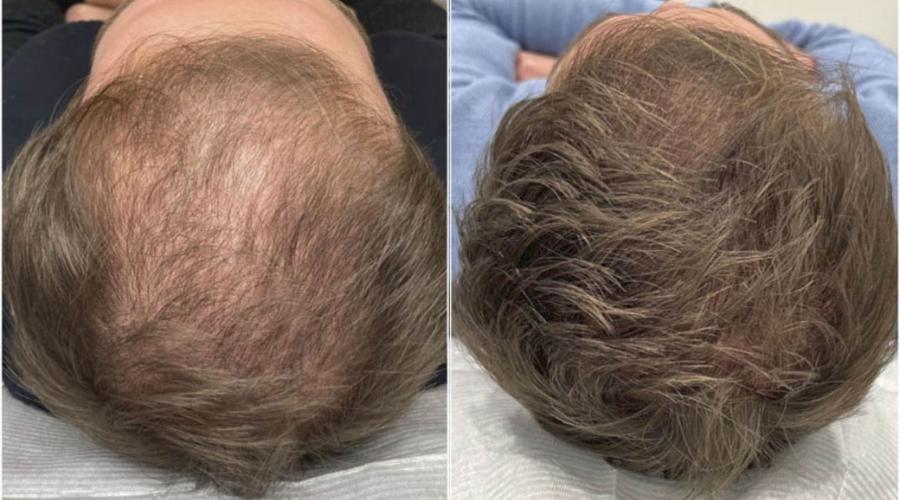 Crystal 5-pin Multi Needle to Treat Hair Loss