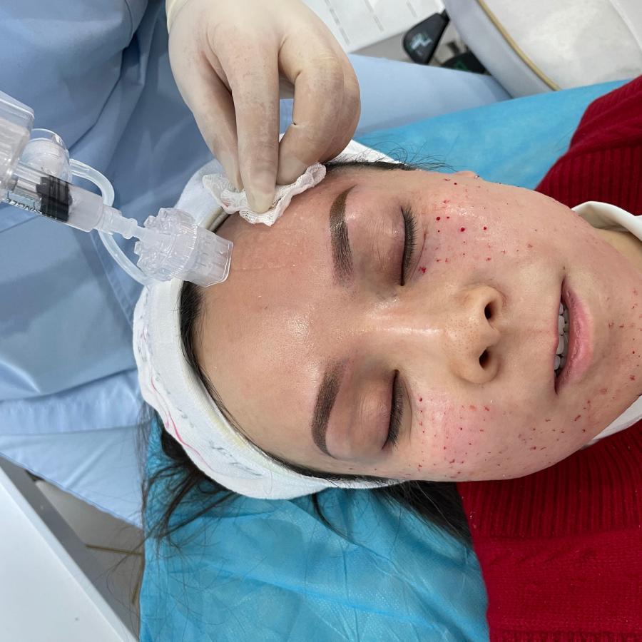 Crystal Multi Needle For Mesotherapy Crystal Multi Needle For Mesotherapy