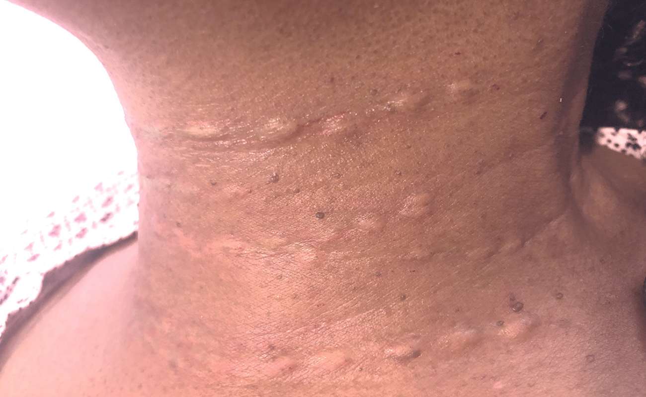 Crystal Multi Needle injects botox into the neck