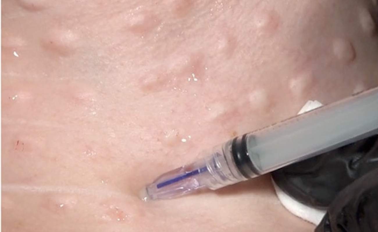 Crystal Multi Needle injects botox into the neck