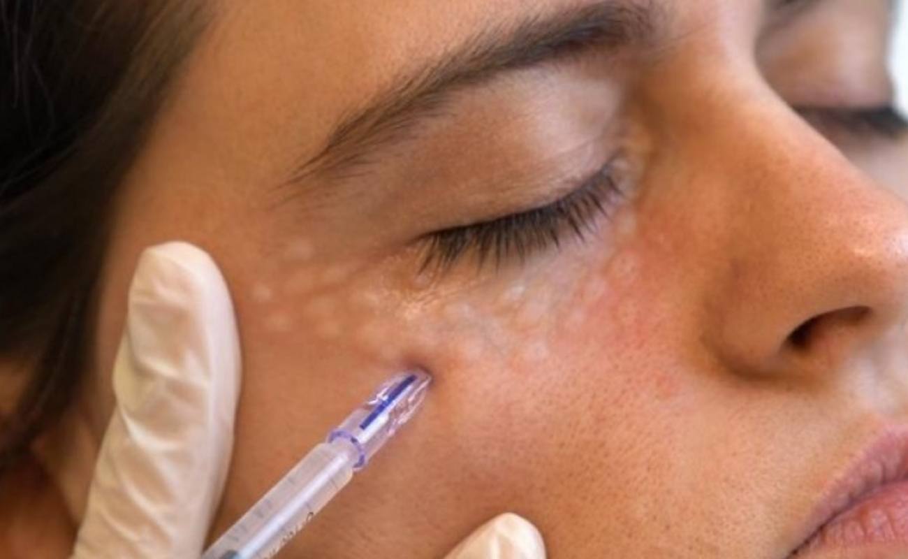 Crystal Multi Needle injects type III collagen into the eyes