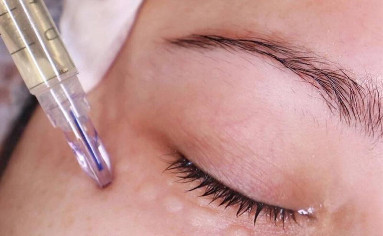 Crystal Multi Needle injects type III collagen into the eyes