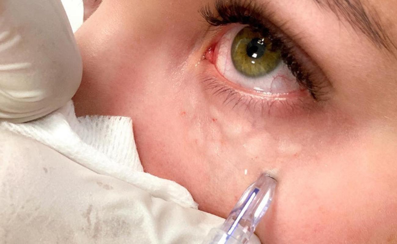 Crystal Multi Needle injects type III collagen into the eyes