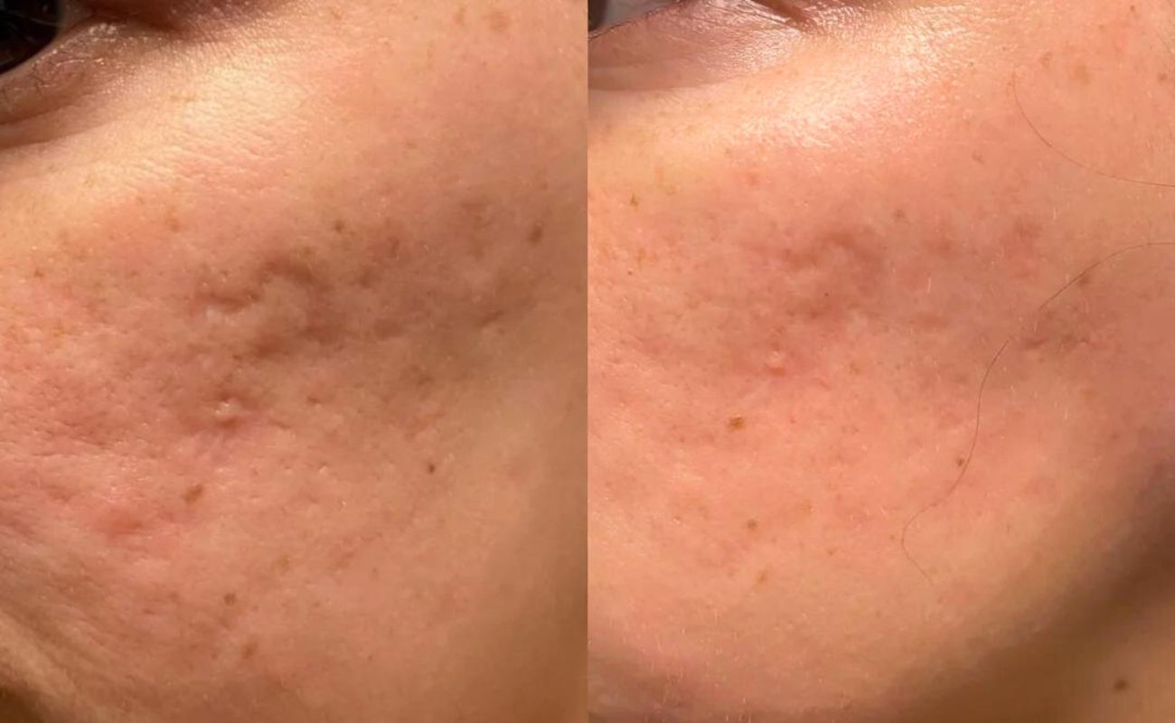 Derma Pen for Face Before& After