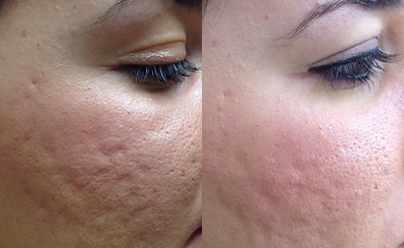 Derma Pen for Face Before& After