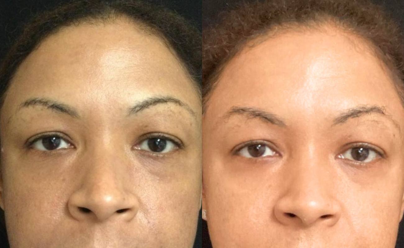 Derma Pen for Face Before& After