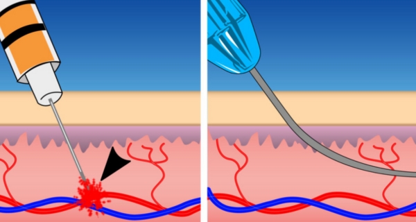 Filler Cannula VS Needle