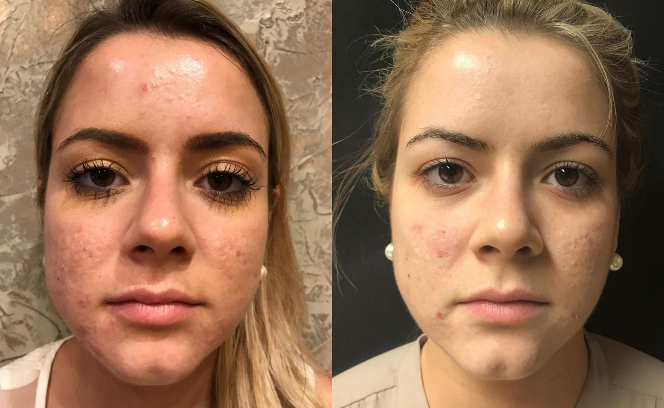 Hydra needle for acne marks