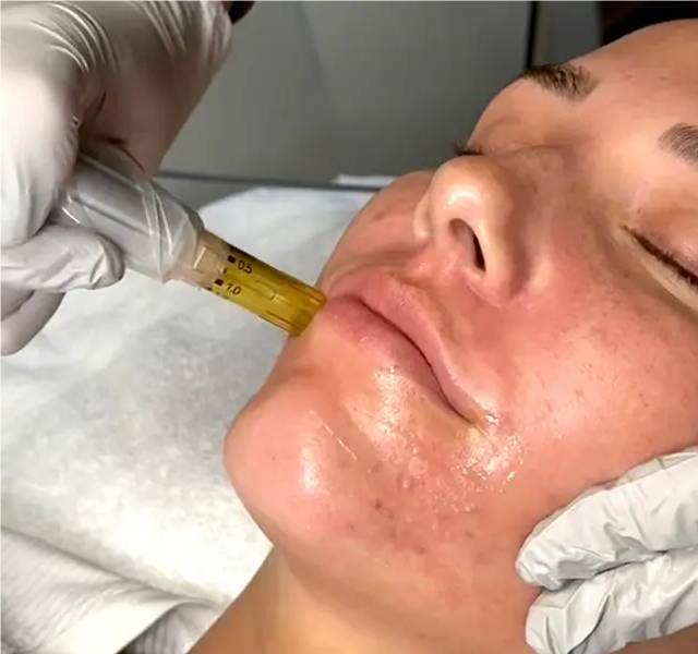 Reviews for Dermapen at Home