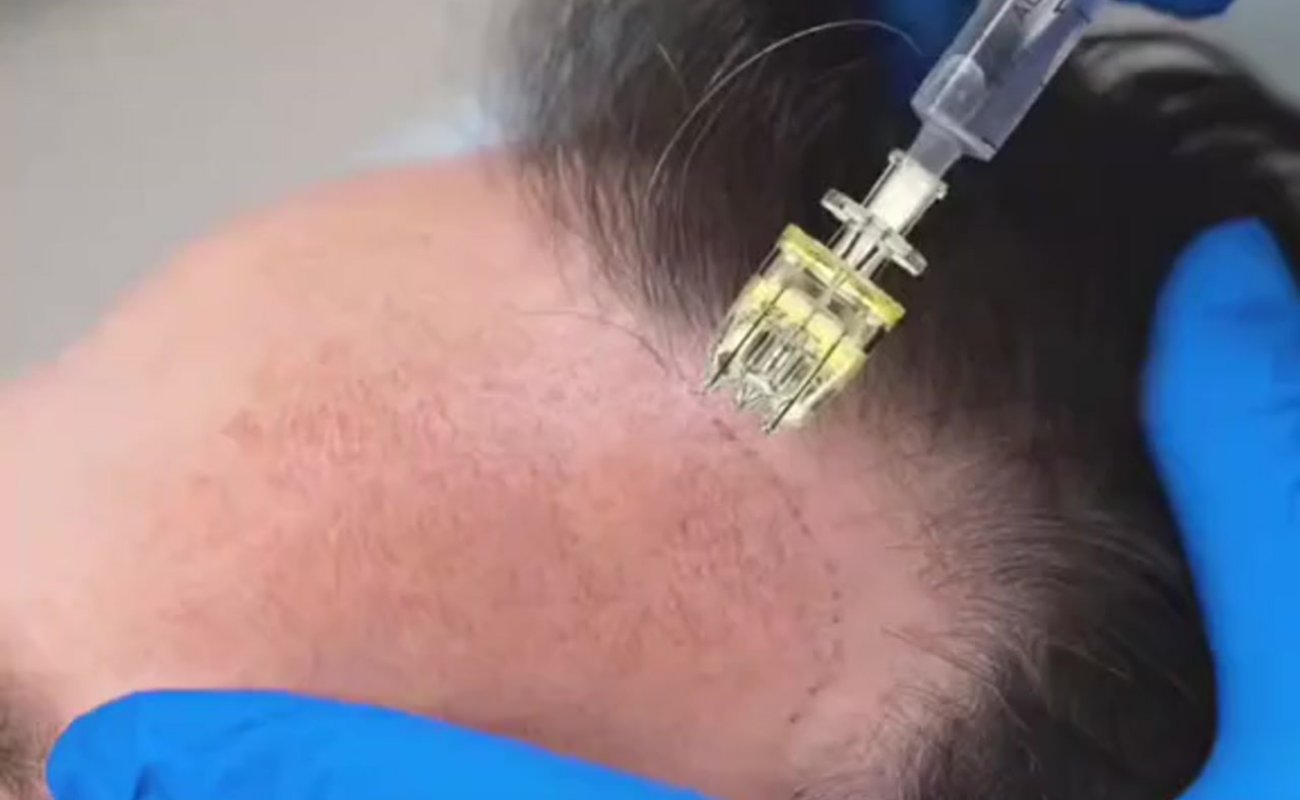 crystal 5 pin needle injection skin booster