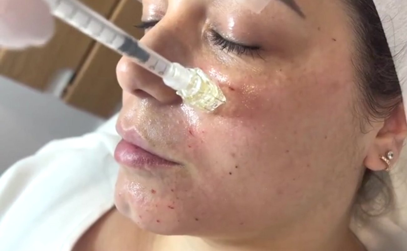crystal 5 pin needle injection skin booster