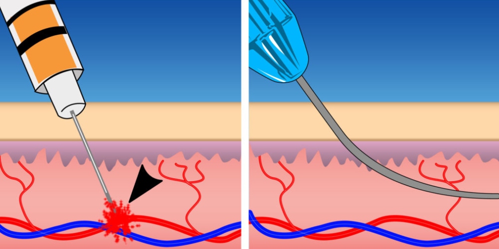 Cannulas VS. needles