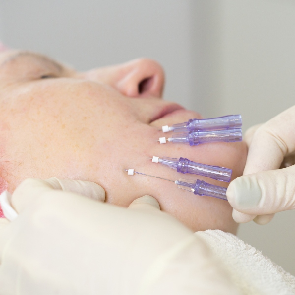 PDO mono thread lift