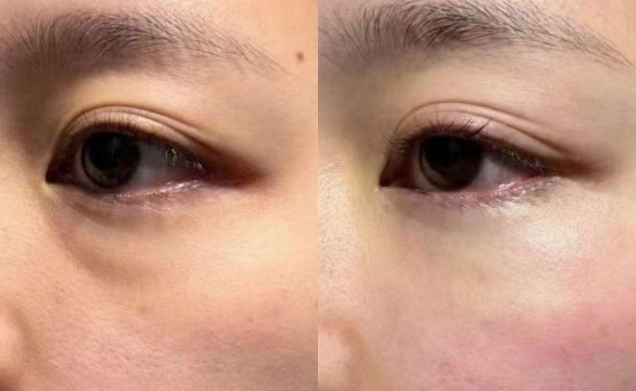Before and after pictures of the eye