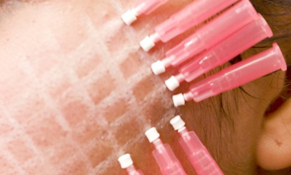 how to prevent thread lift pucker