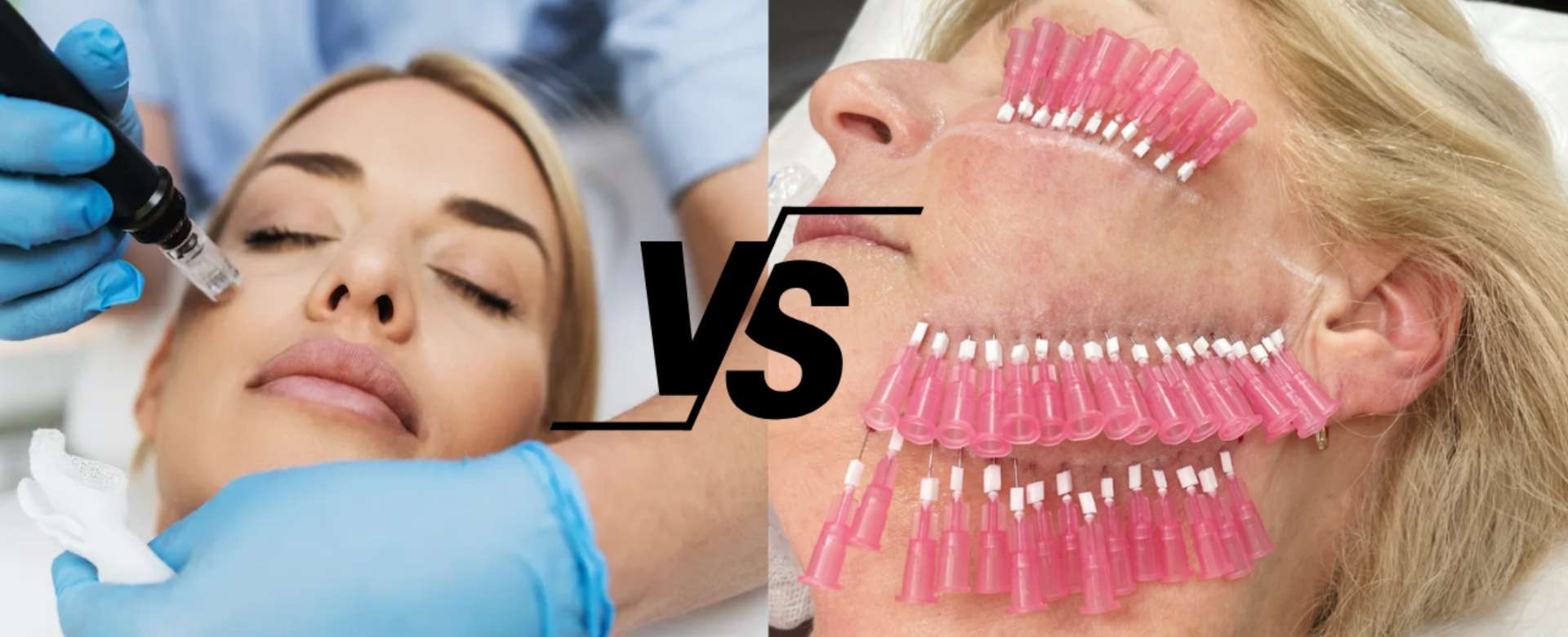 Microneedling VS Smooth Threads For Acne Scars