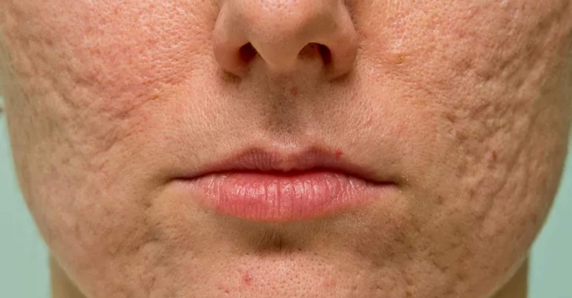 Why Do Acne Scars Happen