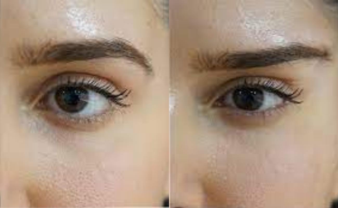 pcl cog threads for eye