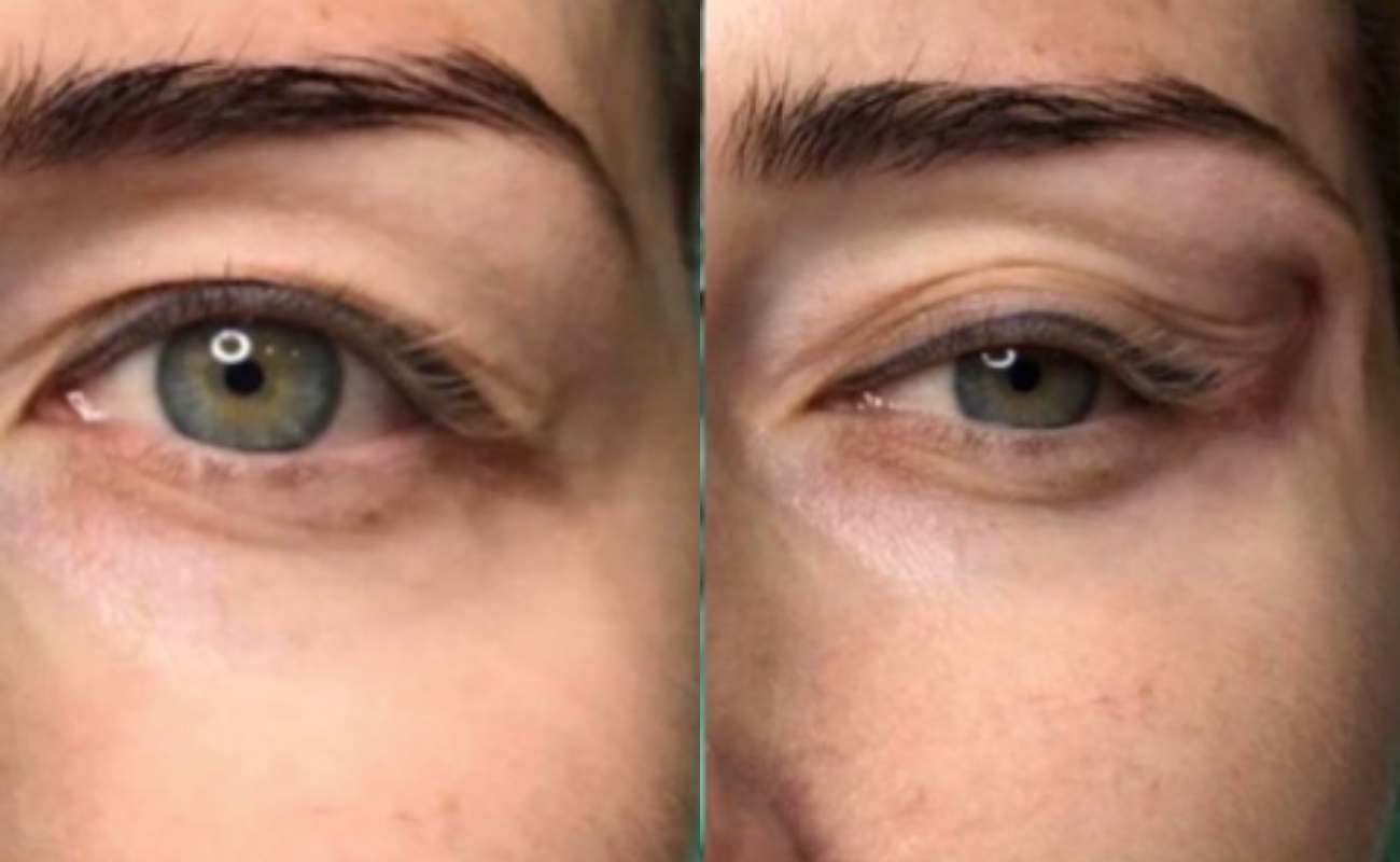 pcl cog threads for eye