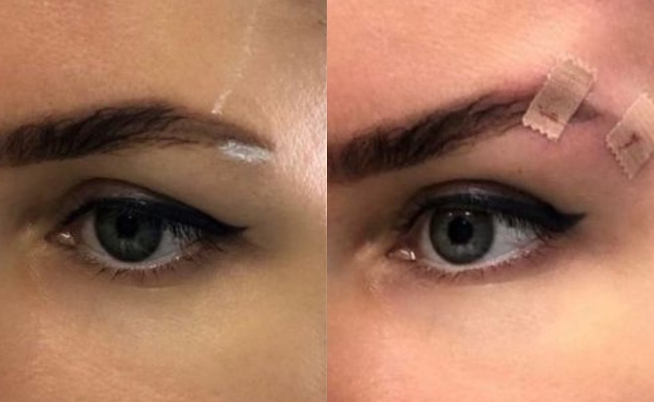 pcl cog threads for eye