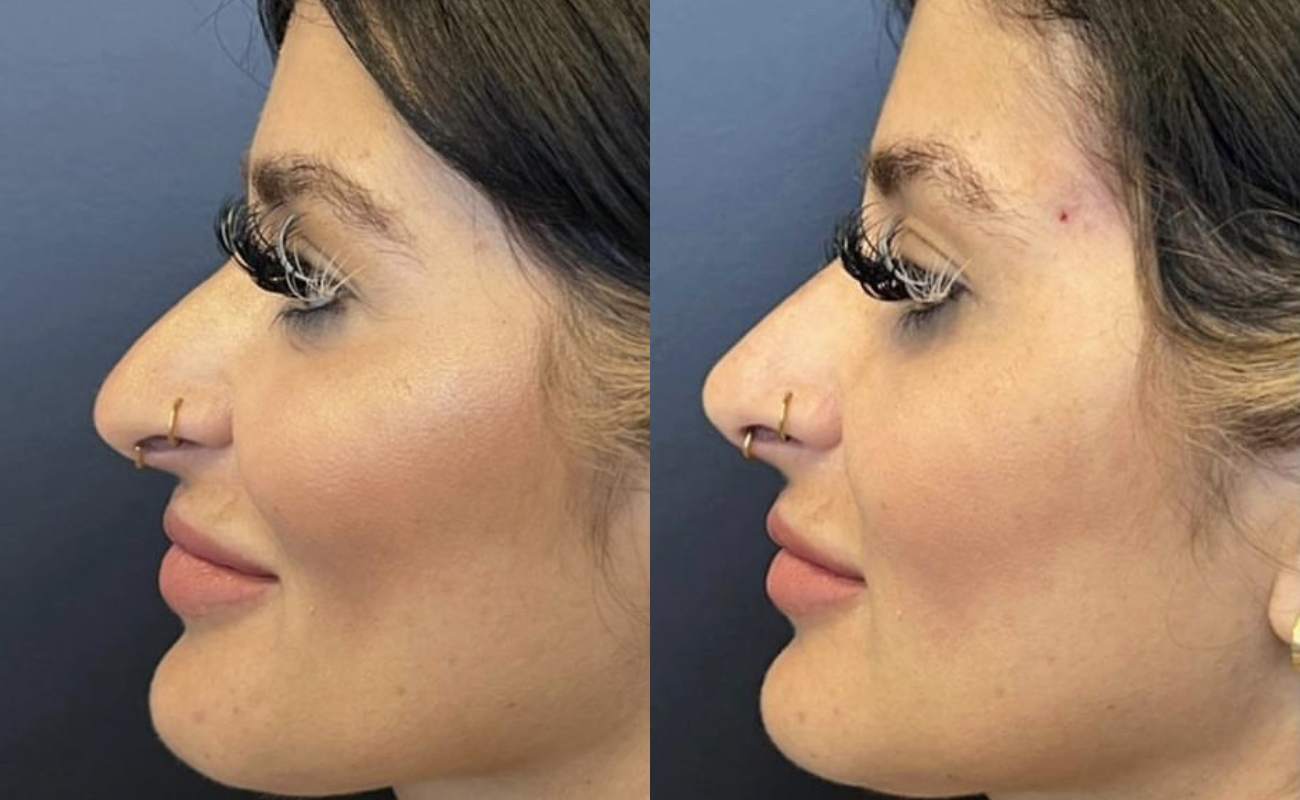 pcl cog threads for nose