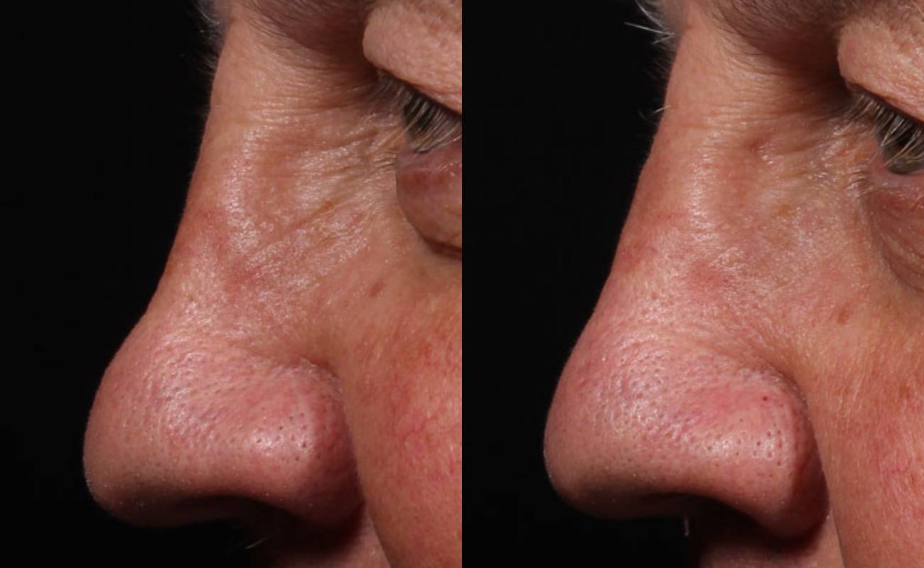 pcl cog threads for nose