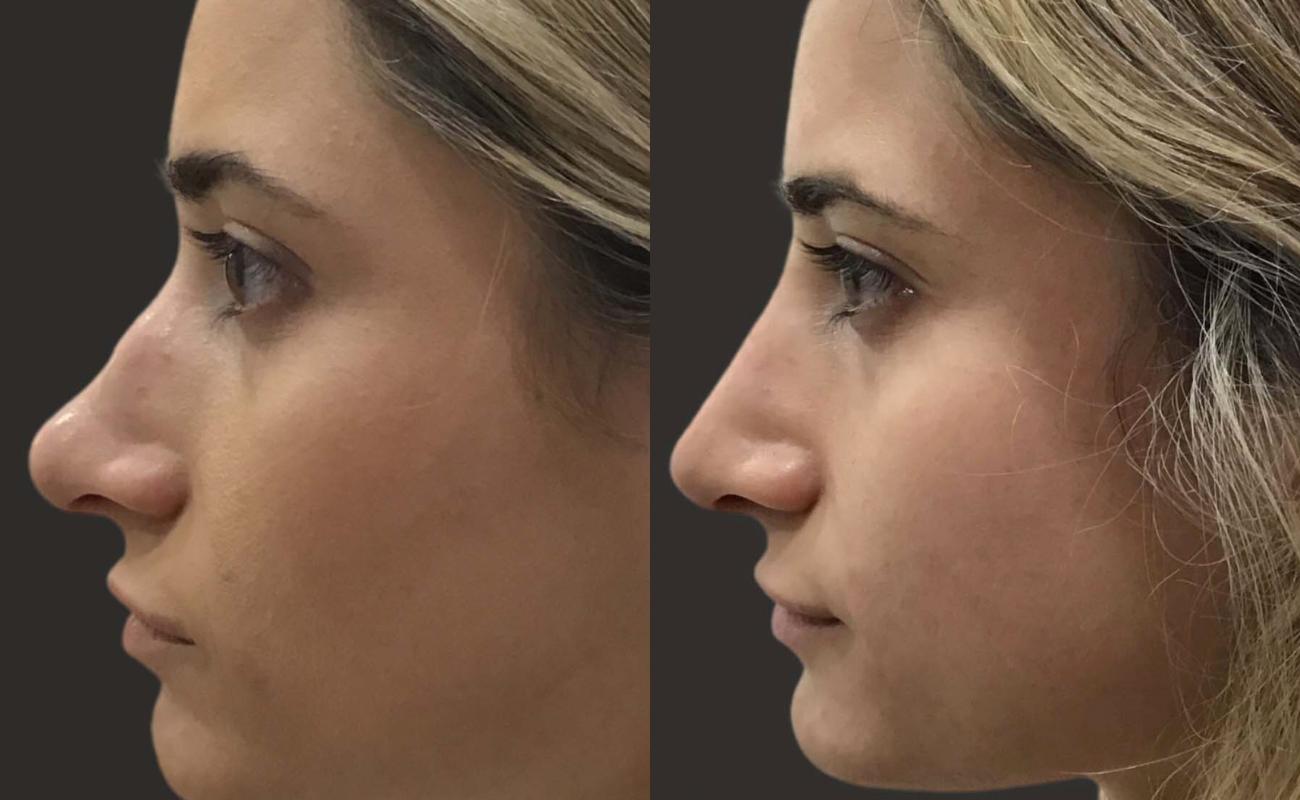 pcl cog threads for nose